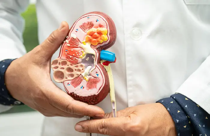 Abordaje de la litiasis renal de repetición